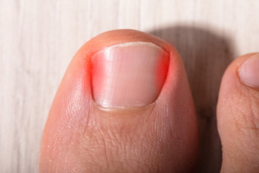 Black toenails: Infection or somethingelse? | Guardian Sun